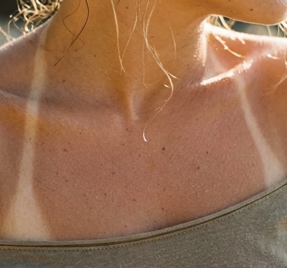 Resultado Bronzeamento Artificial - Dra. Paula Mancini
